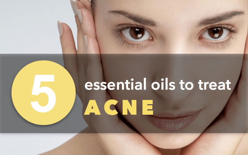 5 Essential Oils to Heal Acne