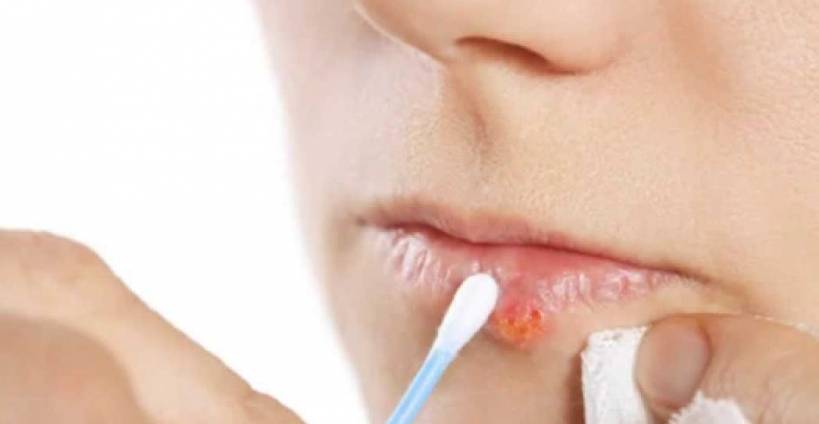 Cold Sore Home Remedies - 7 Top Ways To Stop Your Cold Sores