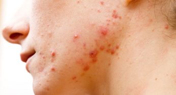 Everything about Cystic Acne