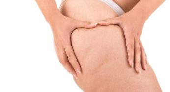 Cellulaze Treatments for Cellulite – What They Are and Is It Worth It?