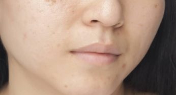 How to get rid of post acne marks