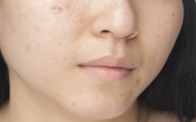The Effects Of Acne Scars - Physically & Emotionally