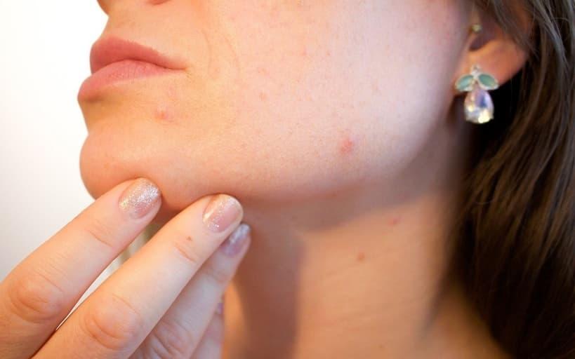 Top Tips To Prevent Acne Breakouts