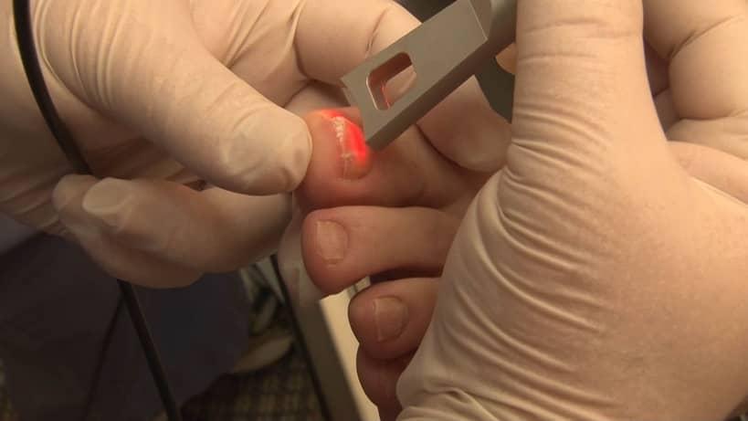 Why Laser Treatment For Toenail Fungus Is Bad