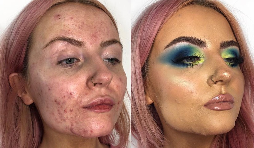 Skin Care Routine for Acne