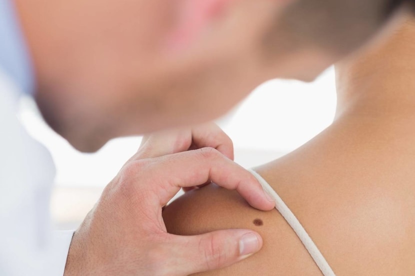 Benign Skin Growths
