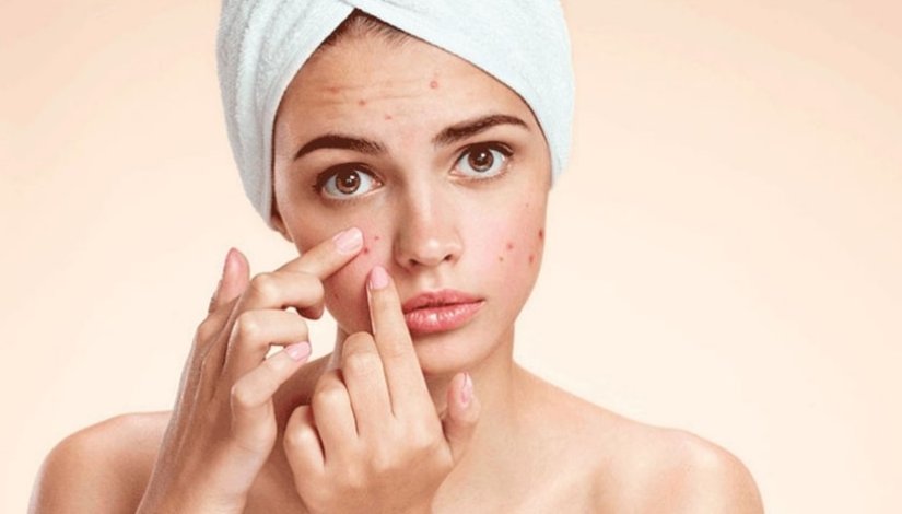 How to Prevent Pimples Using Pimple Cream