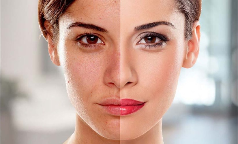 How does Skin Bleaching work – What is Skin Bleaching
