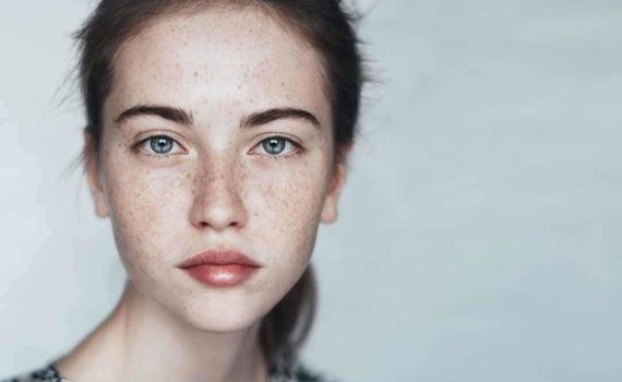 How to treat Hyperpigmentation