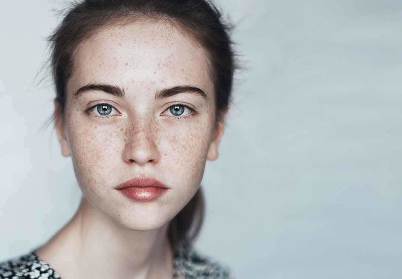 How to treat Hyperpigmentation