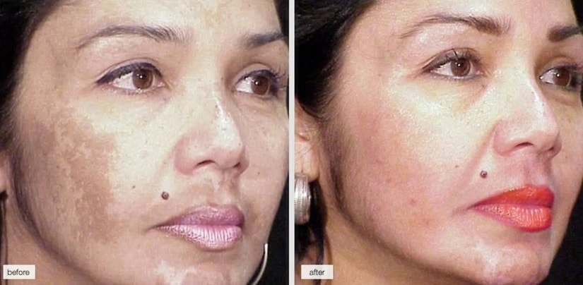 Skin Discoloration Cream – Best Prevention and Treatment Methods