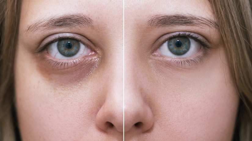 How Dark Circles Deepen With Age