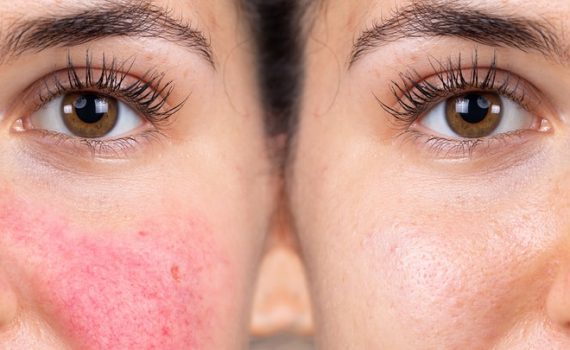 Rosacea Treatment - Why IPL is best