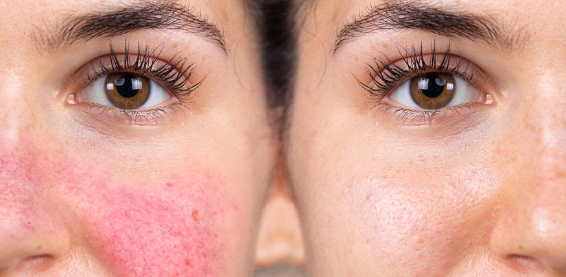 Rosacea Treatment - Why IPL is best