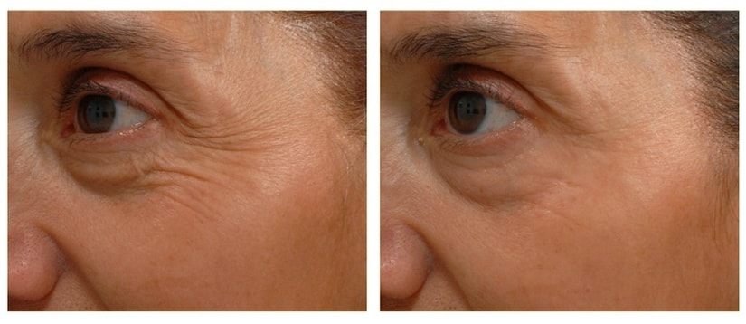 Topical Botox - How do they do it