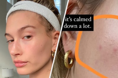 Hailey Bieber Skin Routine For Treating Her Perioral Dermatitis Hailey Bieber Skin Routine For Treating Her Perioral Dermatitis